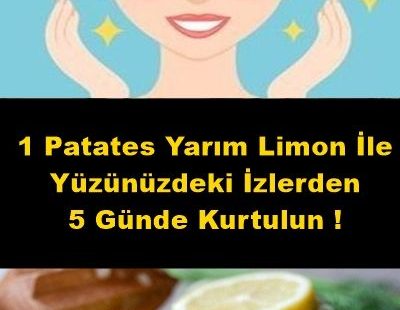 1 Patates Yarım Limon İle Yüzünüzdeki İzlerden 5 Günde Kurtulun