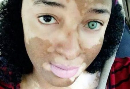 Girl is believed to have the skin condition vitiligo, where pigment is lost from some areas.