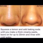 Get Rid Of Blackheads!